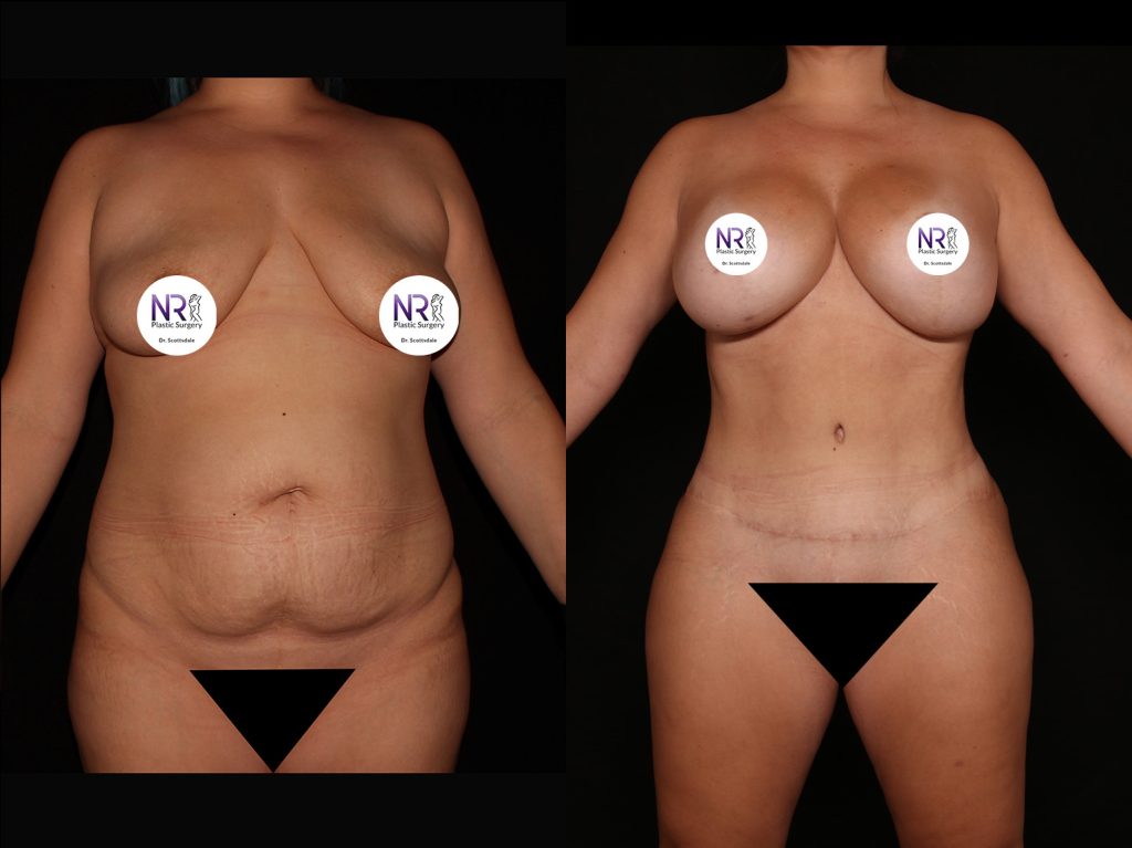 Tummy Tuck in Scottsdale Az