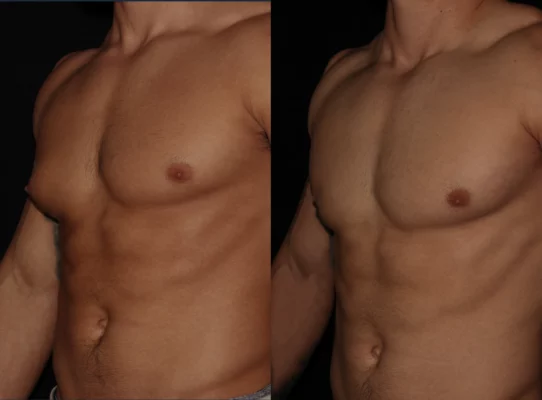 Gynecomastia 1