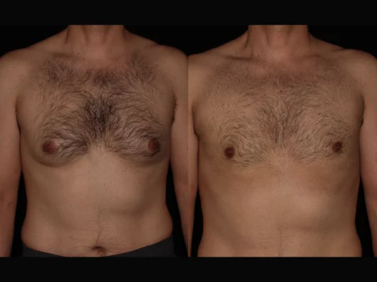 Gynecomastia in Scottsdale AZ