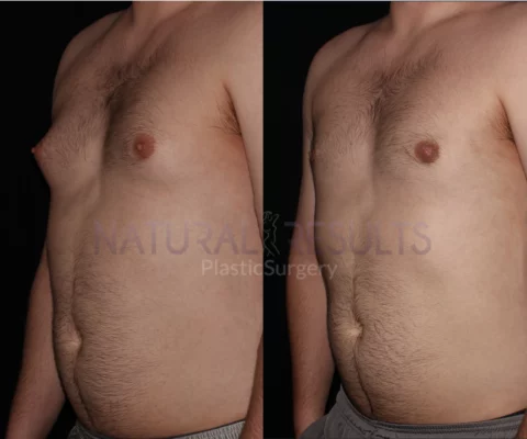 Gynecomastia 3