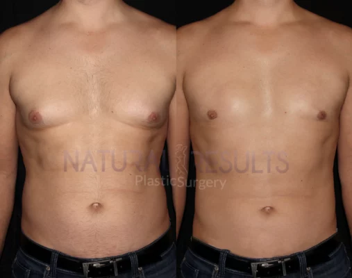Gynecomastia 4