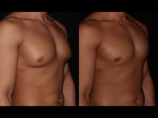 Gynecomastia 5